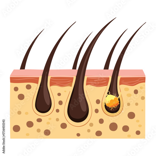 Illustration of an Inflamed Hair Follicle with a Sebaceous Gland Blockage, Representing Folliculitis or a Minor Scalp Infection	