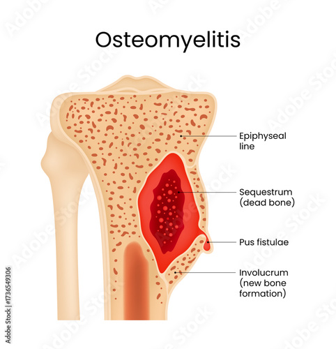 Diagram of the Bone Osteomyelitis