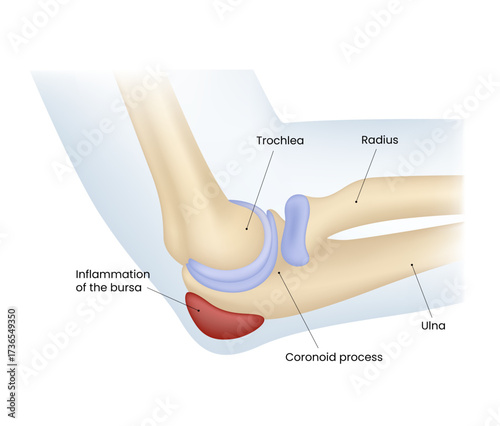 Elbow Joint Anatomy Inflammation of the Bursa