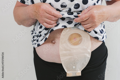 An elderly woman with a colostomy bag on her stomach.
