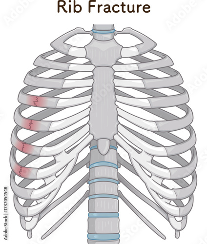 肋骨骨折のイラスト　Broken rib illustration