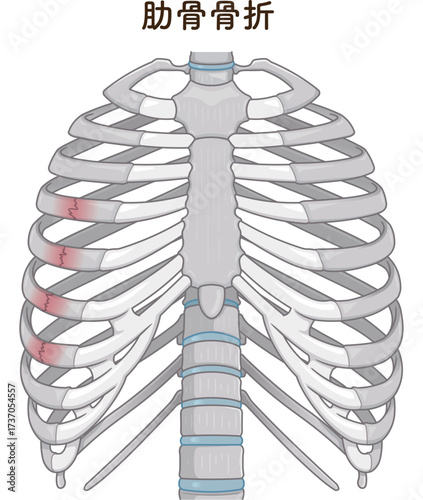 肋骨骨折のイラスト　Broken rib illustration
