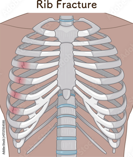 肋骨骨折のイラスト　Broken rib illustration