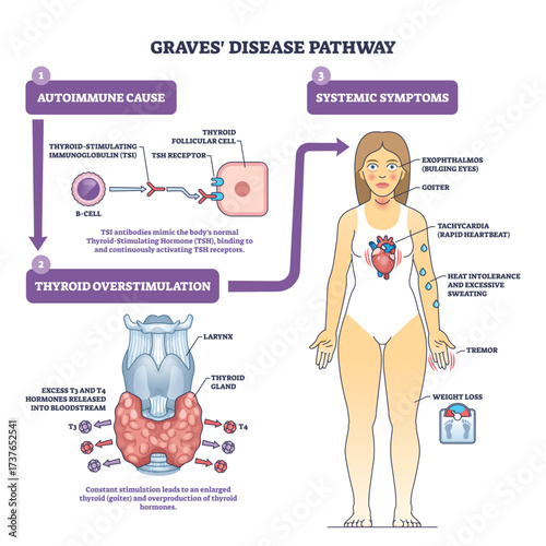 Graves disease pathway brief diagram explains autoimmune antibodies overstimulating the thyroid with a patient figure showing symptoms, thyroid, antibodies, woman. Outline diagram