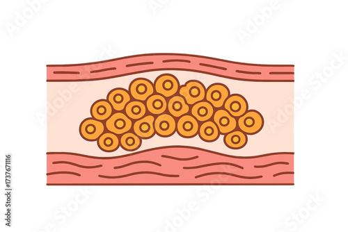 Cross-section of an artery with atherosclerosis plaque buildup causing vascular obstruction and disease