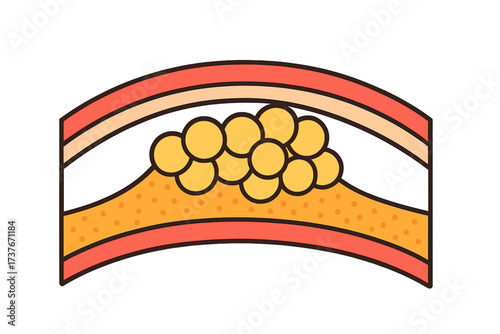 Atherosclerosis plaque buildup in human artery causing arterial narrowing and blockage