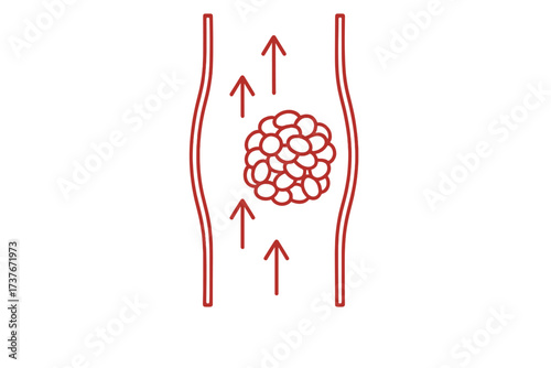 Human blood vessel with tumorous growth causing significant flow obstruction