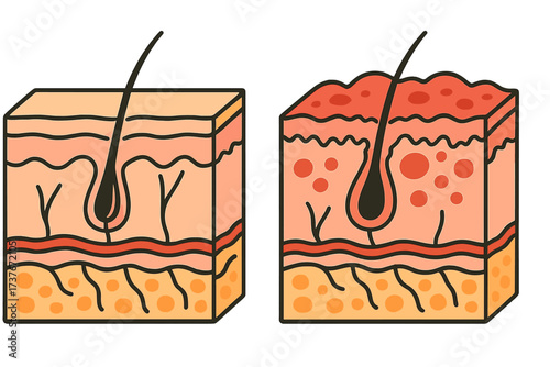 Detailed comparison of healthy human skin structure and inflamed skin condition