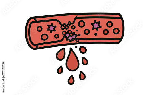 Ruptured blood vessel showing internal bleeding and escaping blood cells