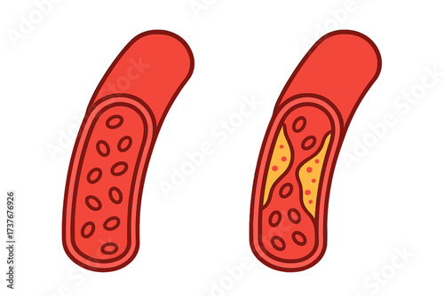 Healthy blood vessel compared to artery with cholesterol plaque buildup and atherosclerosis