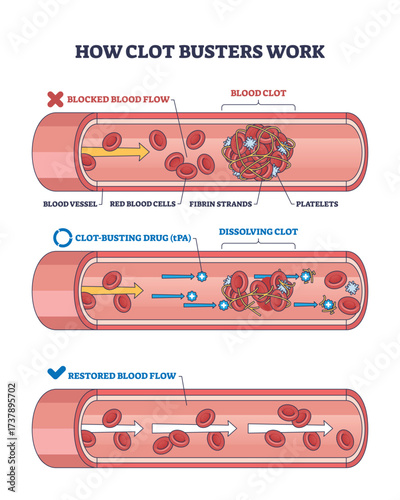 Clot busters work by dissolving blood clots in vessels, restoring blood flow, key objects, blood clot, drug, blood vessel. Outline diagram
