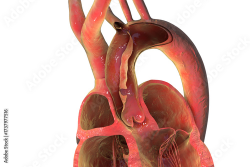 Ascending aortic dissection, 3D illustration