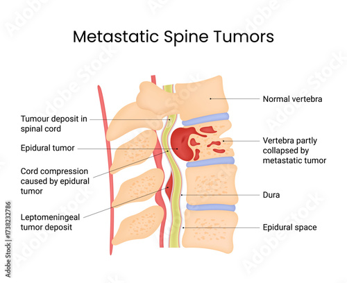 Metastatic Spine Tumors Anatomical Illustration