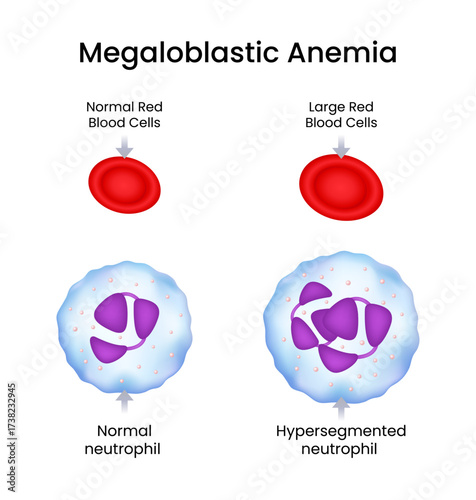 Megaloblastic Anemia Red Blood Cells and Neutrophils Comparison