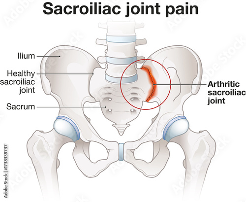 Sacroiliac joint pain. Arthritic sacroliac joint illustration