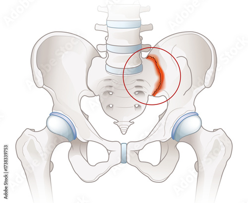 Sacroiliac joint pain. Arthritic sacroliac joint illustration