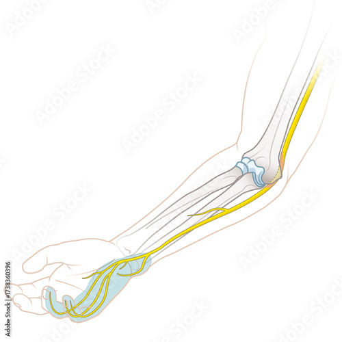 Cubital Tunnel Syndrome. Illustration of Ulnar Nerve Compression in the Elbow