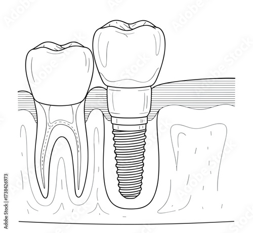 Dental implant diagram in minimalist line art style, black and white