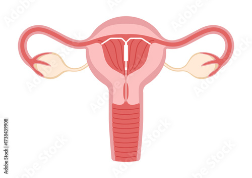 Intrauterine spiral, IUD-birth control and pregnancy prevention. Intrauterine device in the uterus. EPS10 Vector illustration