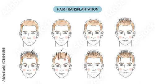 Illustrations Depicting Various Stages and Outcomes of Hair Transplantation Procedures for Men