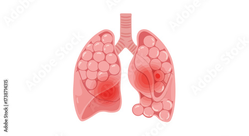 Detailed illustration of human lungs highlighting areas of inflammation and potential disease for medical education and awareness campaigns