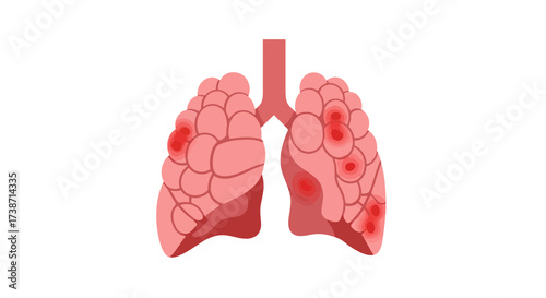 Diseased lungs graphic highlighting inflammation and respiratory distress for medical awareness and educational content