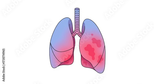 Stunning stylized lungs illustration showing medical condition with vibrant color gradients, perfect for health education and awareness campaigns