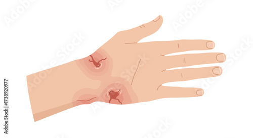 Wound care illustration showing injuries and skin damage on hand, perfect for medical education or healthcare marketing around treatment and recovery