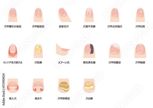 爪の病気一覧