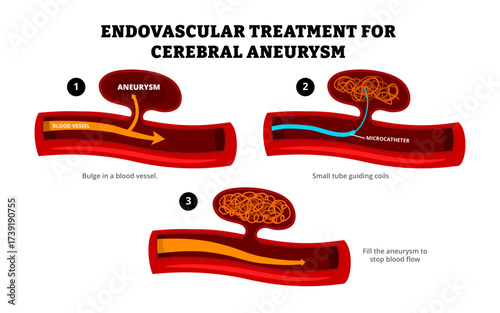 Endovascular treatment for a cerebral aneurysm steps. Treatment process. Labeled bulge in blood vessel, microcatheter small tube guiding coils, fill aneurysm to stop blood flow. Healthcare poster.