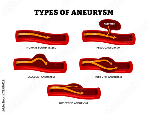 Different types of aneurysm types set collection. Abnormal artery in aorta or brain. Labeled blood vessel with pseudoaneurysm, saccular, fusiform, dissecting aneurysm. Medical poster infographic.