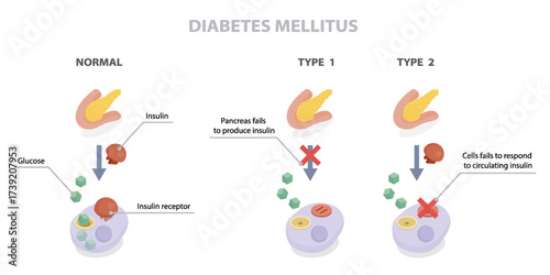 Diabetes mellitus. Difference between type one diabetes and type two diabetes. Flat isometric vector illustration diagram. Educational medical information banner.
