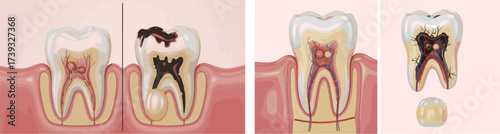Tooth Decay and Root Canal Treatment Diagram | Dental Health Education Illustration for Dentists and Oral Care