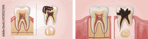 Tooth Decay Progression Stages Diagram | Dental Health Education Materials for Dentists and Patients