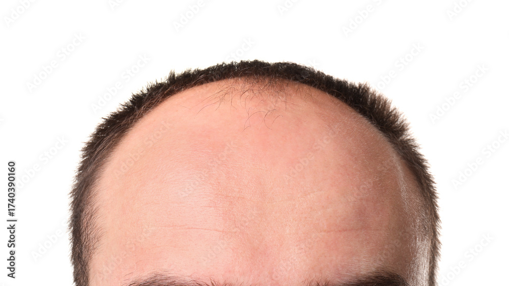 Fototapeta premium Baldness problem. Man with receding hairline on white background, closeup