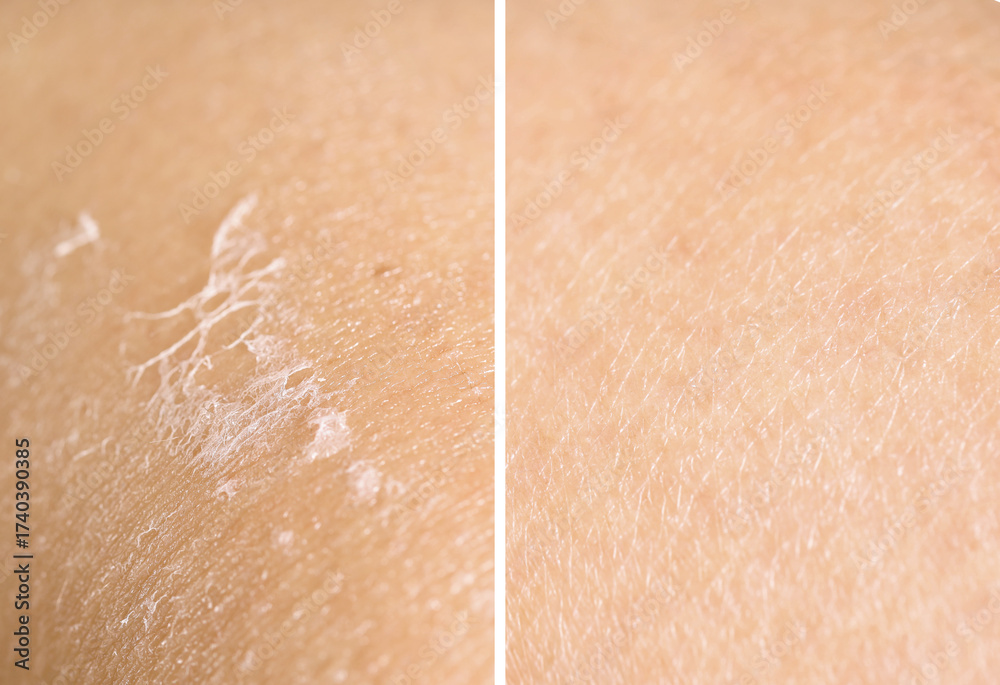 Fototapeta premium Dry skin on one side and moisturized on another, collage before and after