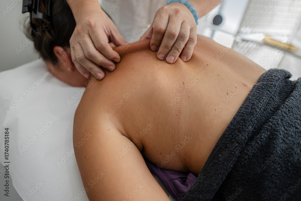 Fototapeta premium Practitioner performing cupping and acupuncture treatment on back
