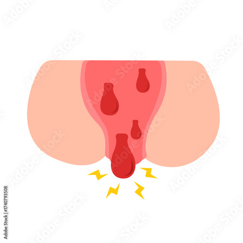 hemorrhoid disease and symptoms concept