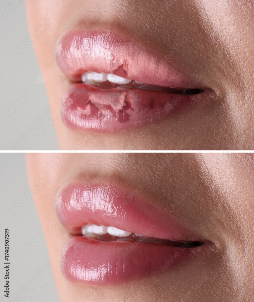 Obraz premium Lip care. Woman with chapped and dry skin before and healthy skin after moisturizing treatment, closeup. Collage on grey background