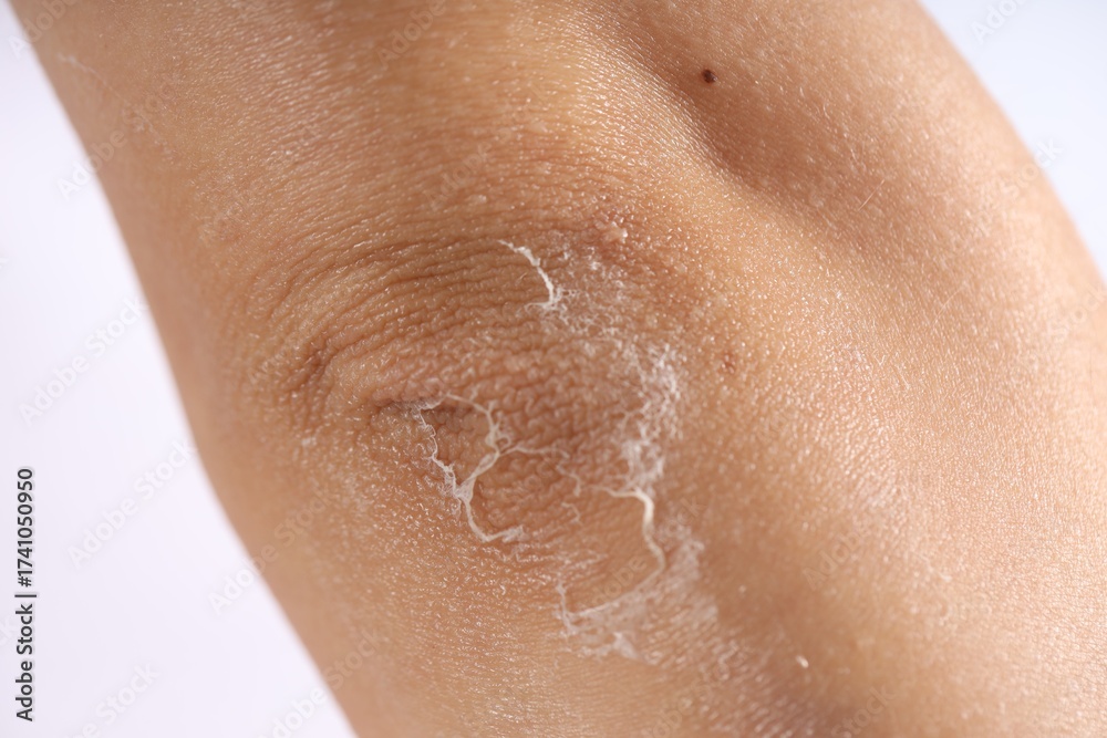 Fototapeta premium Woman with dry skin on her elbow against light background, closeup