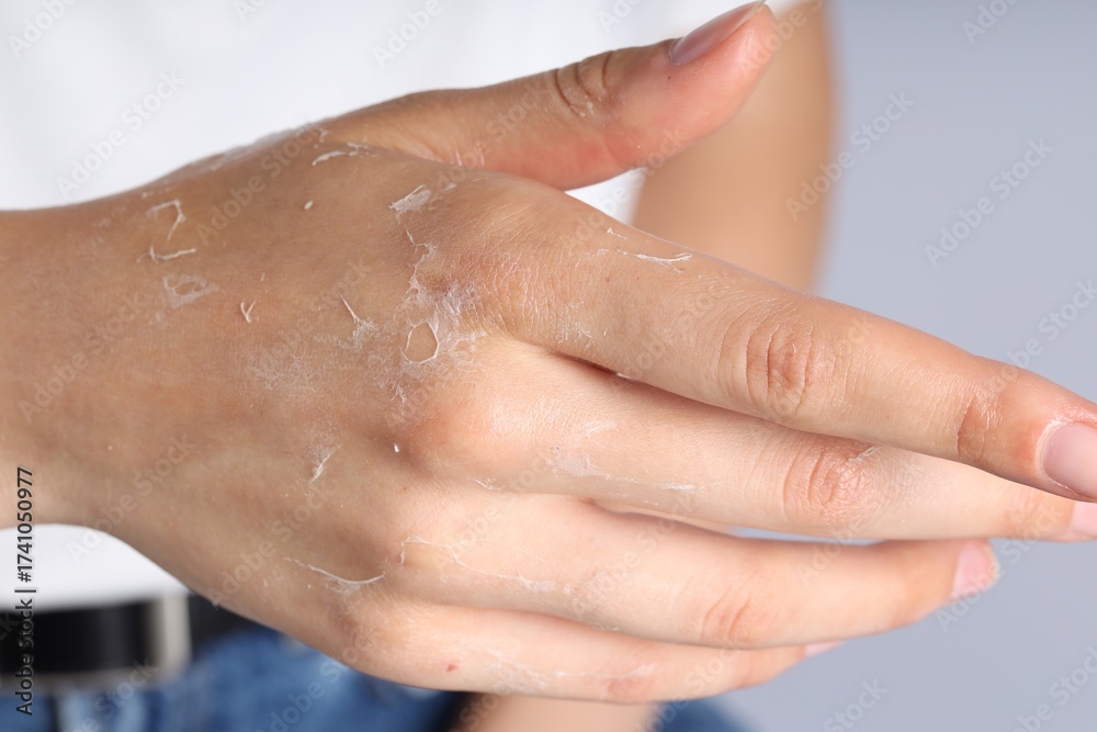 Fototapeta premium Woman with dry skin on her hand against light background, closeup