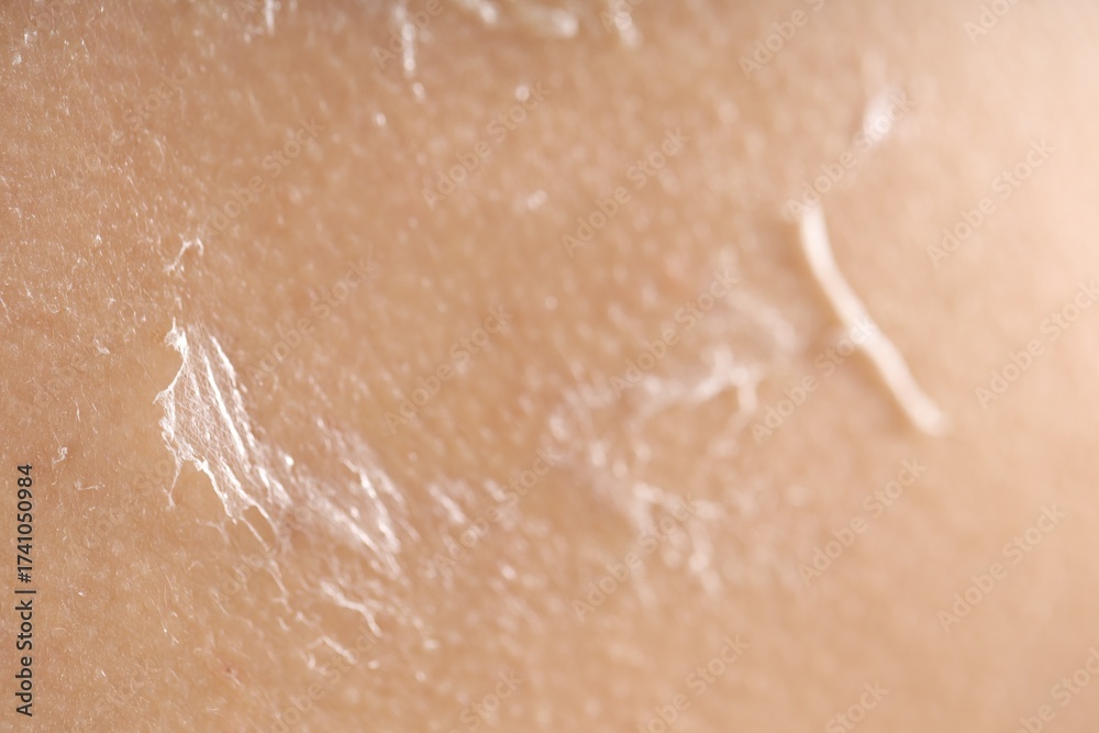 Fototapeta premium Closeup view of woman with dry skin