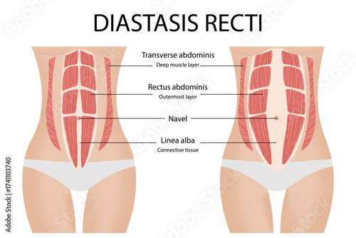 Variations of diastasis recti. Separation of the muscles