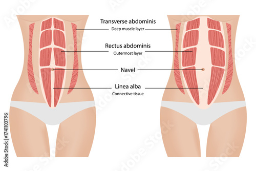 Variations of diastasis recti. Separation of the muscles