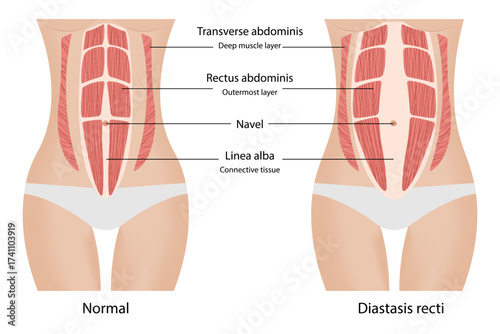 Diastasis recti. Separation of the muscles