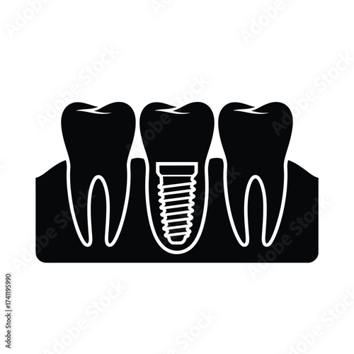 Dental implant illustration showing tooth root and bone structure