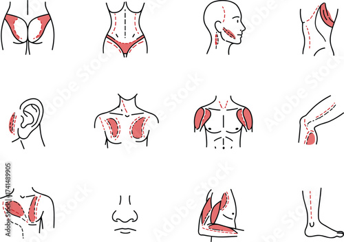 Medical body anatomy illustration, cosmetic surgery areas, liposuction treatment, plastic surgery zones, muscle diagram, fat removal, healthcare vector design, aesthetic procedure, clinic