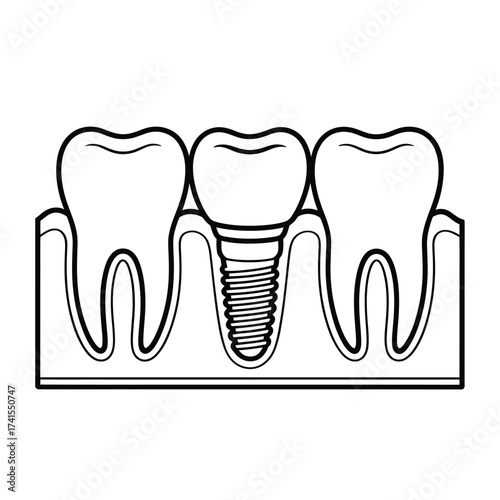 Diagram of a dental implant replacing a missing tooth