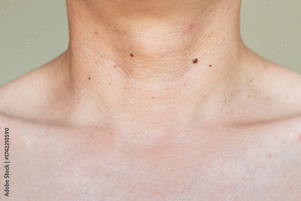 Fototapeta premium Close-up photo of the neck of a man with many brown growths on the skin, papillomas. Skin diseases. Human papillomavirus. Laser removal of papillomas