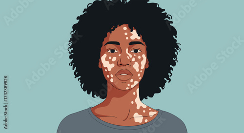 Understanding the causes and effects of vitiligo on skin health and personal well-being.